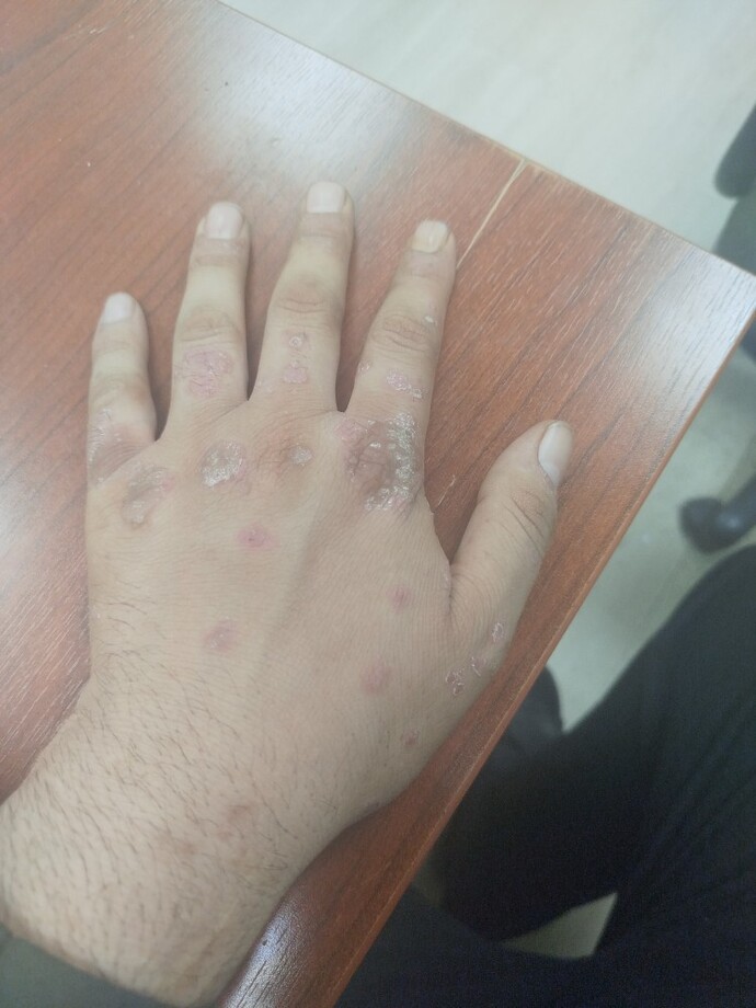 Sedef hastalığı olanlar, hangi tedaviyle rahatladınız, deniz mi termal mi, diyet ne olmalı?