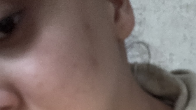Pigmentli lekelere karşı ne iyi gelir?