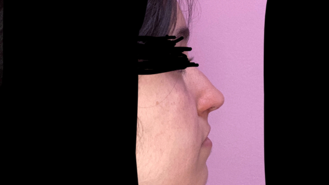 Burnum çok büyük, estetik ameliyat gerçekten profili kurtarır mı sizce?