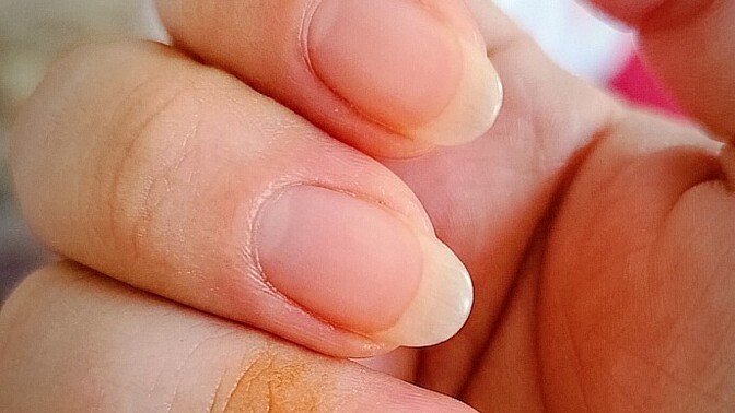 Sabah uyandığımda yüzük parmağımda silinmeyen leke neden oluşmuş olabilir?