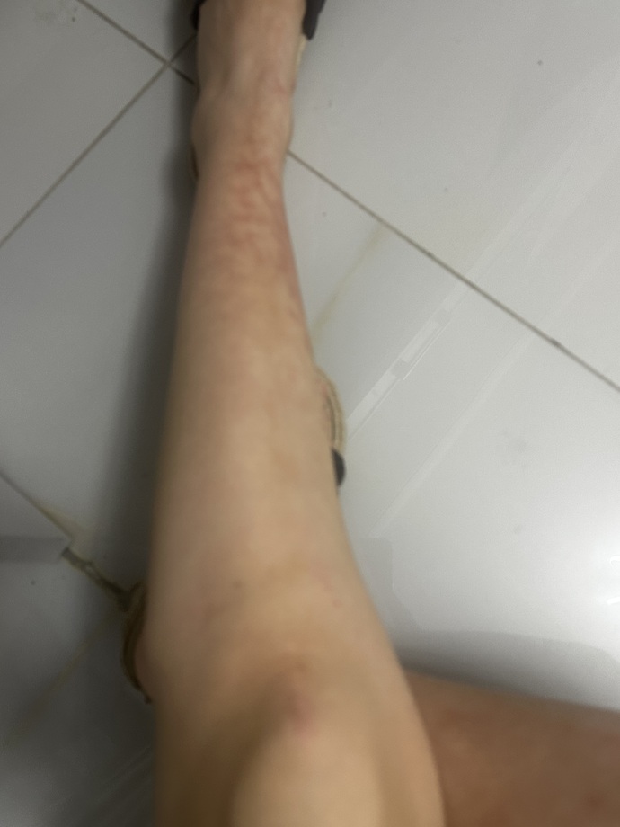 Ayak bileğimde hep böyle mor damarlar çıkıyor neden olabilir?
