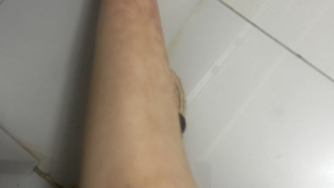 Ayak bileğimde hep böyle mor damarlar çıkıyor neden olabilir?