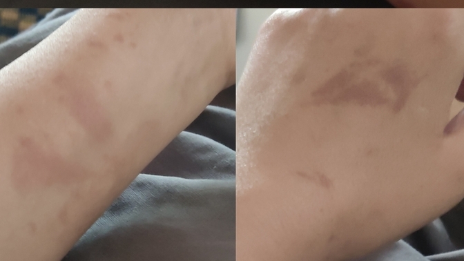 El ve kolda bir anda çıkan yanık izi gibi lekeler neden olur, tehlikeli mi?