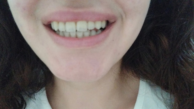 Sigara içmiyorum, kahve de az içiyorum ama dişlerim neden sarı, evde diş beyazlatmak için ne yapabilirim?