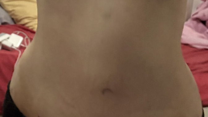 Yeni lipo yaptırdım, belim sizce yeterince ince ve orantılı duruyor mu?