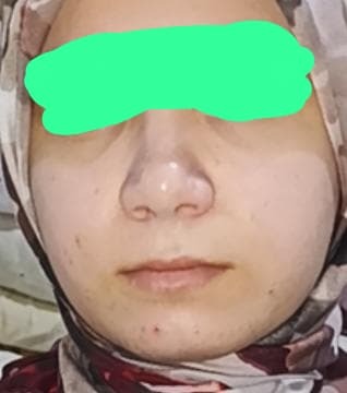 Arkidişler benim yanaklarım böyle şekilde 56 kiloya düşersem çok zayıflar mı yüzüm sizce?
