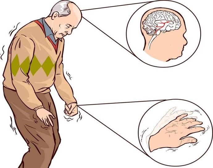 Eliniz çok titrer mi?