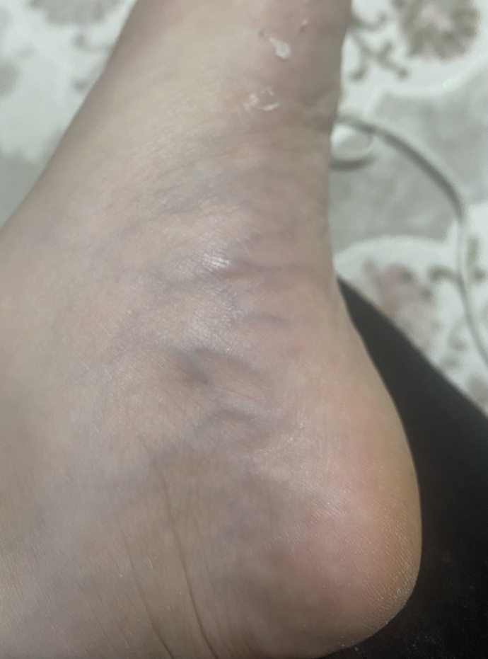 Damarımın şişmesi normal mi, neden olur ne zaman doktora gitmeliyim?