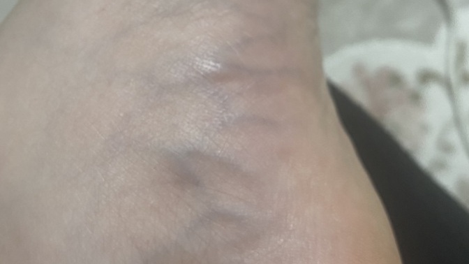 Damarımın şişmesi normal mi, neden olur ne zaman doktora gitmeliyim?