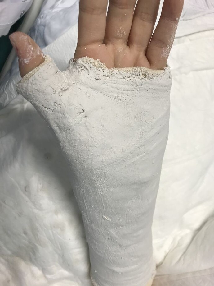 Hiç alçıya alındınız mı?