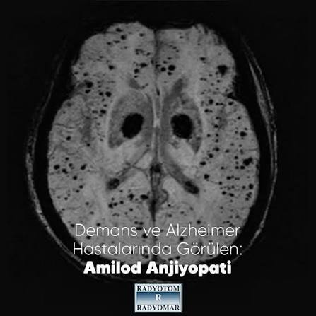 Şeker hastası olmamak için beslenmenize dikkat ediyor musunuz? Peki şekerin Alzheimer riskini katkat arttırdığını biliyor muydunuz?