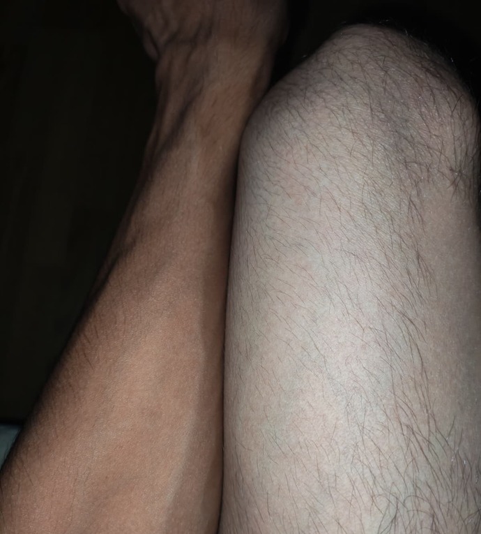 Güneşte çok yanıp kararan kol ve bacak cildi nasıl açılır, ne yapmalıyım?