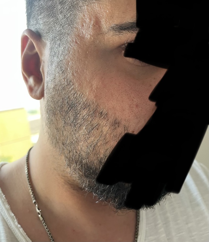 Kızlar, Cildim yüzünden aşırı depresyondayım gerçekten çok mu kötü yoksa ben mi büyütüyorum?