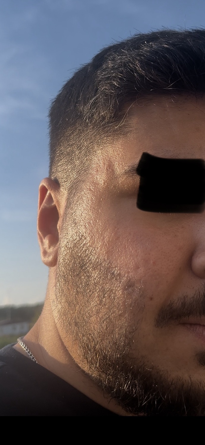 Kızlar, Cildim yüzünden aşırı depresyondayım gerçekten çok mu kötü yoksa ben mi büyütüyorum?