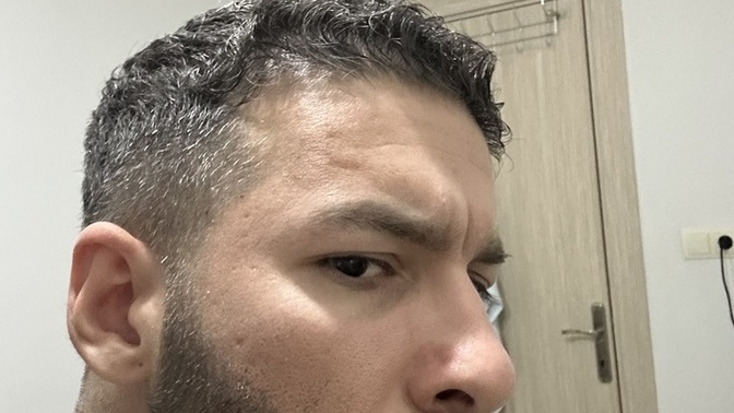 Yüzümde böyle oldu gözenekli çok mu kötü duruyor nasıl geçet?
