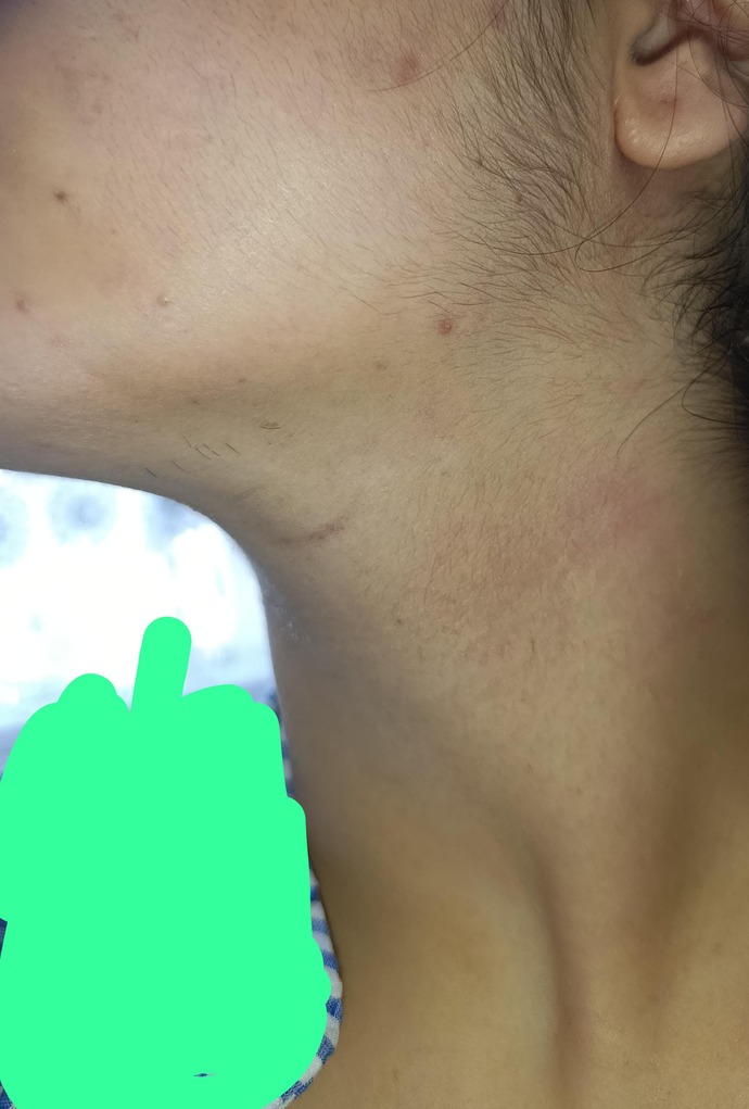 Sizce bu kadar tüylenme olması anormal mi anormal ise hangi doktora gidebilirim fikri olan varsa söylesin boynum neden pul pul?