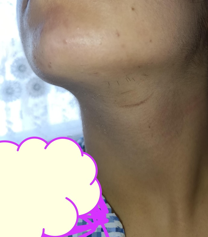 Sizce bu kadar tüylenme olması anormal mi anormal ise hangi doktora gidebilirim fikri olan varsa söylesin boynum neden pul pul?