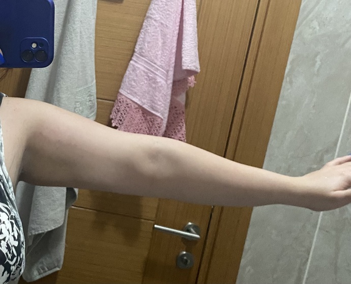 100 kilodan 60 kiloya inince kol sarkması olur mu, şu an kollarım sarkık mı?
