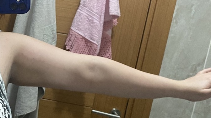 100 kilodan 60 kiloya inince kol sarkması olur mu, şu an kollarım sarkık mı?