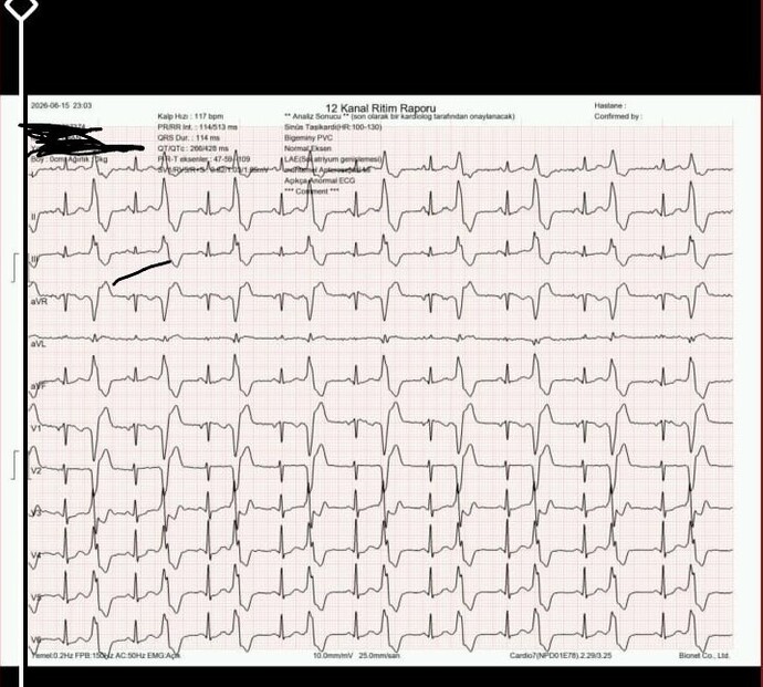 Bu EKG sonucu normal mi, anormal mi nasıl anlayabilirim?