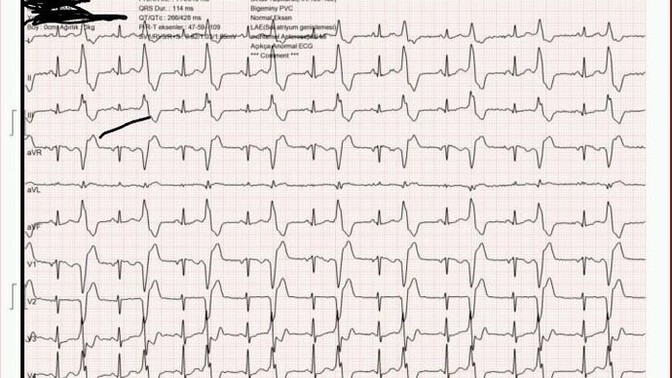 Bu EKG sonucu normal mi, anormal mi nasıl anlayabilirim?
