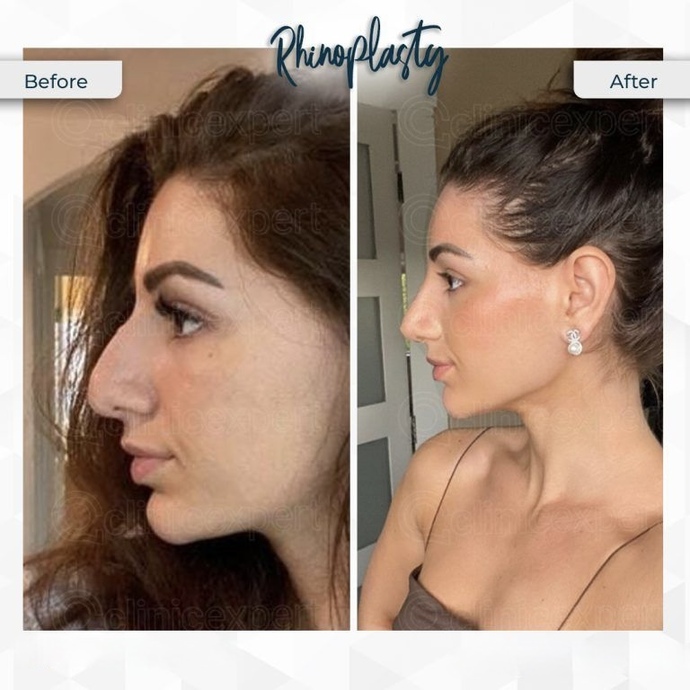 Tıbbi endikasyon olmadan rinoplasti ameliyatı olur musun?