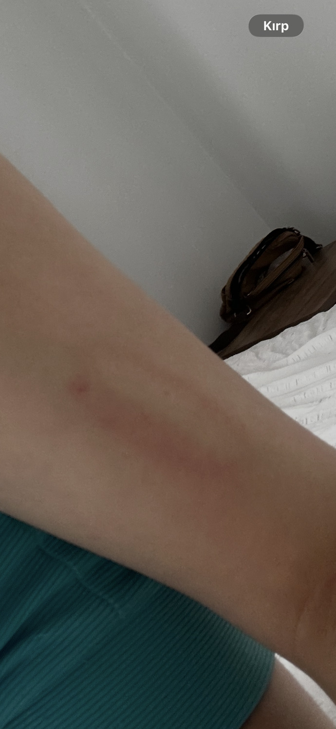 Bu leke gidrr mi?