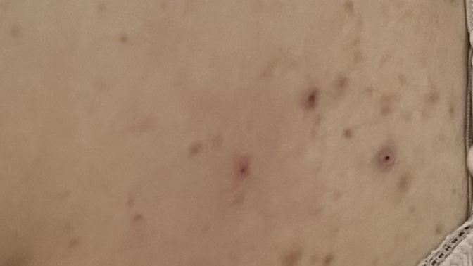 Daha önceden sırtında böyle lekeler olan var mı nasıl geçirdiniz?