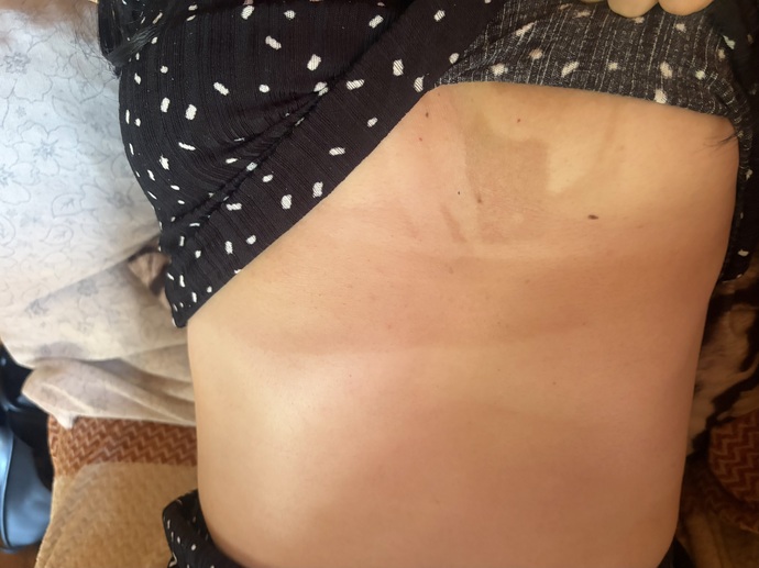 Güneşlendikten sonra göbek bölgemde oluşan kararma neden geçti gibi olup hala duruyor?