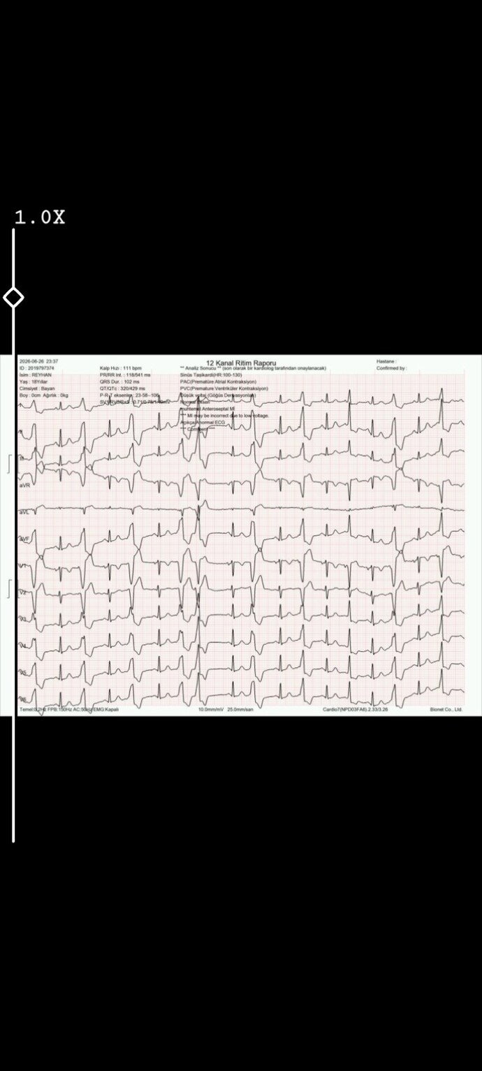 Bu EKG sonucu kötü mü, kalbimde ciddi bir sorun olabileceğini mi gösteriyor?