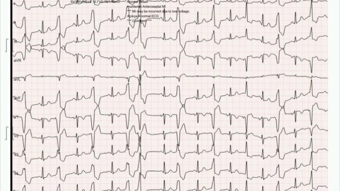 Bu EKG sonucu kötü mü, kalbimde ciddi bir sorun olabileceğini mi gösteriyor?