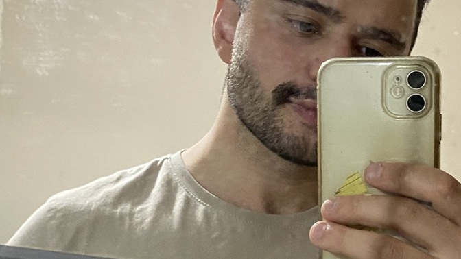 Saç gitti nasıl oldi?