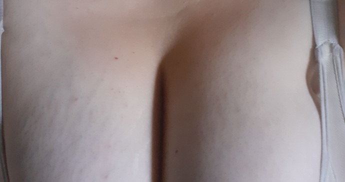 Göğüs çatlakları lazer tedaviyle tamamen geçer mi, bu işleme para vermeye değer mi?