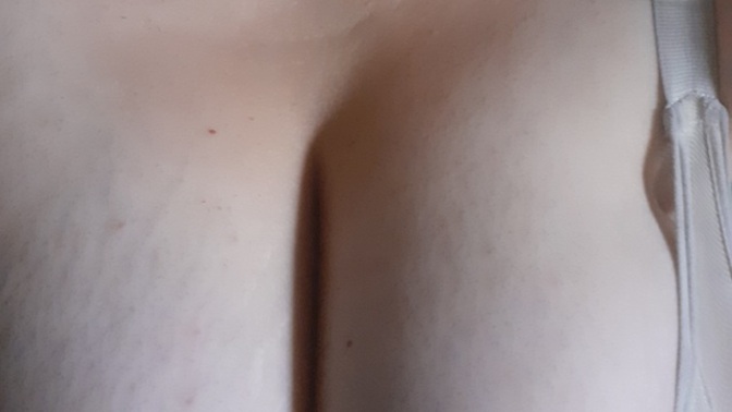 Göğüs çatlakları lazer tedaviyle tamamen geçer mi, bu işleme para vermeye değer mi?