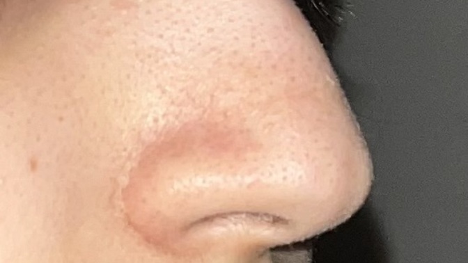 Burnumu yaptırmalı mıyım eğri mi kötü mü?
