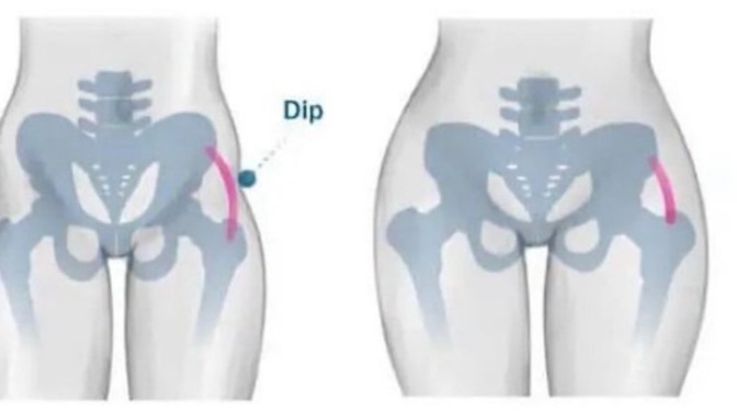 Kadınlarda ki hip dips kötü mü duruyor?