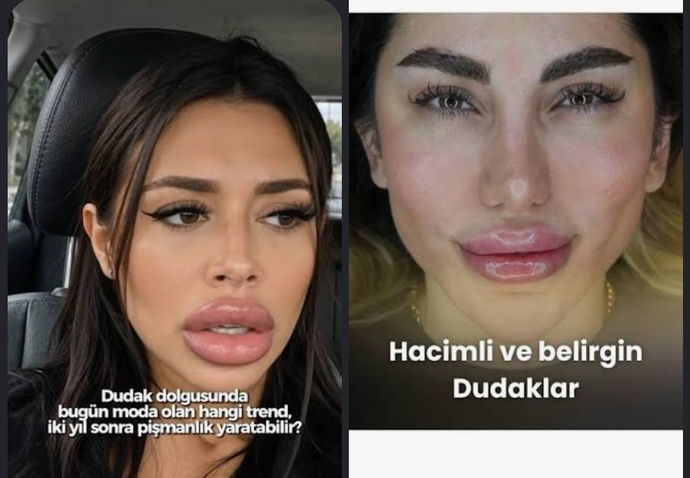 Burun ve üst dudak estetiği kızları gerçekten çirkinleştiriyor mu, sizce abartıldı mı?