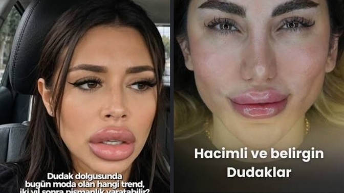 Burun ve üst dudak estetiği kızları gerçekten çirkinleştiriyor mu, sizce abartıldı mı?