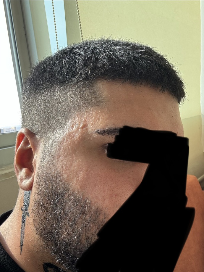 Cildimde sivilce izleri var özgüvenimi etkiliyor çok mu kötü yoksa erkek cildi olarak normal mi?