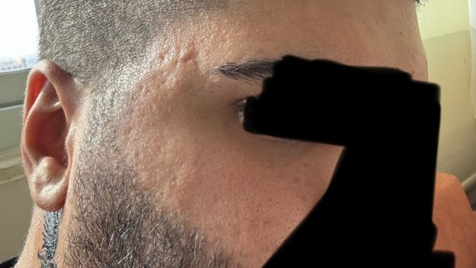 Cildimde sivilce izleri var özgüvenimi etkiliyor çok mu kötü yoksa erkek cildi olarak normal mi?