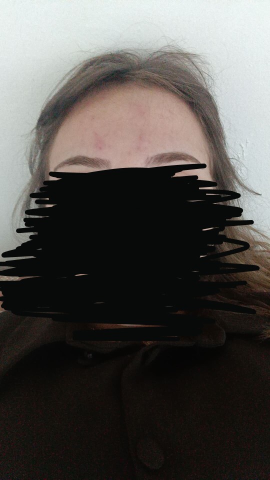Alnım geniş ve kahkül sivilce yapıyor, alnı geniş gösteren saç modeli yerine ne kullanabilirim?