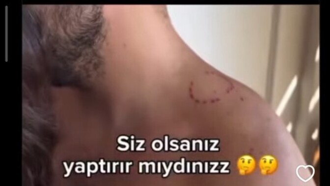 Eşinizin ısırık izini dövme yapar mıydınız 😂?