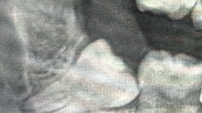20’lik dişimi ağrısada ağrımasada çektireyim mi?