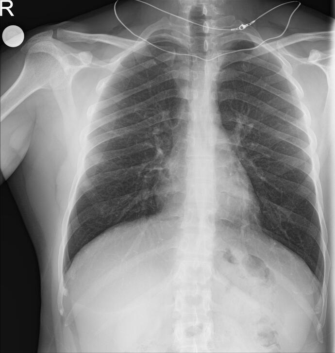 Akciğer grafisi sonucum çıktı, doktor var mı nasıl durumum?