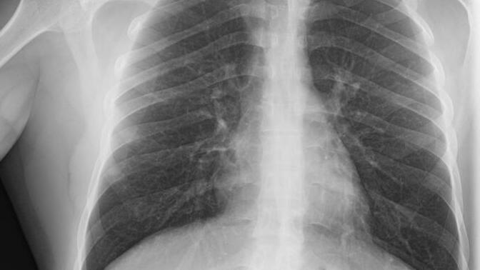 Akciğer grafisi sonucum çıktı, doktor var mı nasıl durumum?