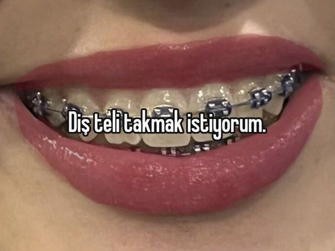 Sizce diş teli güzelliğe engel mi?