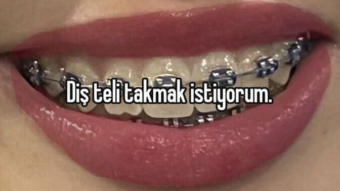 Sizce diş teli güzelliğe engel mi?