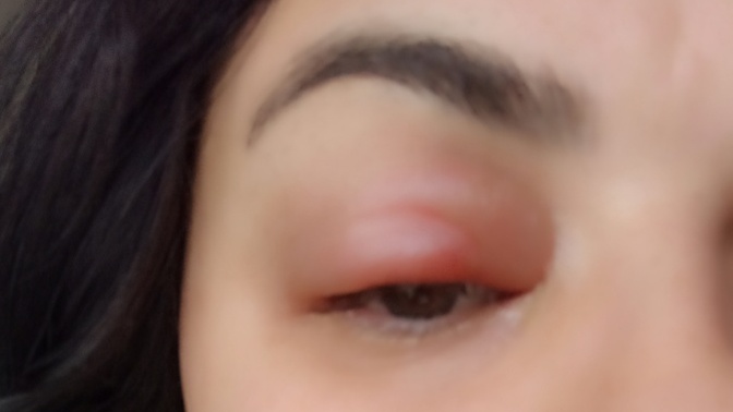 Arpacık böyle şişer mi?