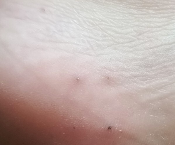 Ayak topuğu yanında deri altında oluşan küçük siyah noktalar neden olur, nasıl geçer?
