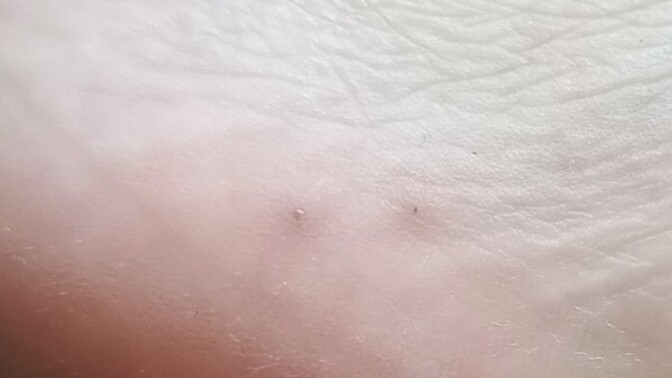 Ayak topuğu yanında deri altında oluşan küçük siyah noktalar neden olur, nasıl geçer?